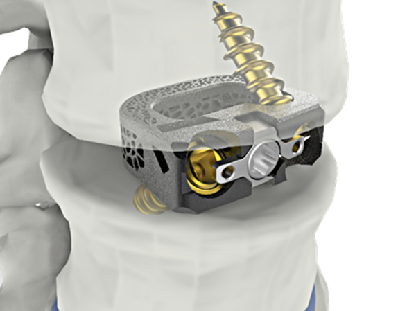 ▲척추 융합기기 ‘유니스페이스(UniSpace® TPLIF Cage, 요추 케이지)’ 美 FDA 승인 획득